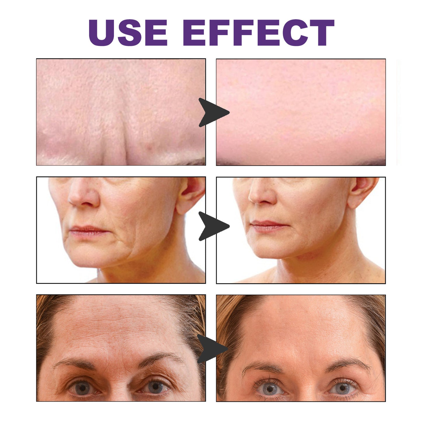 EELHOE Facial Wrinkle Patch, Droop Decree Line Lift Facial Skin Tightens Mouth Line Cheek Patch